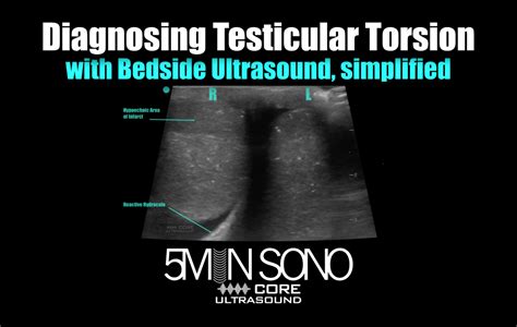 how to identify testicular torsion